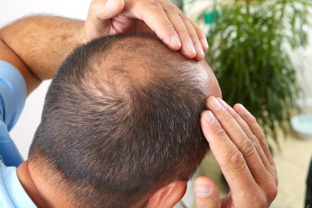 Signs You Need Hair Transplant Treatment