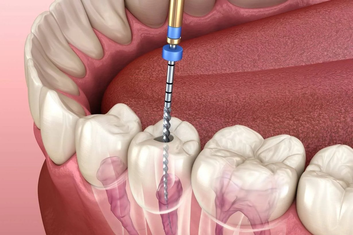 Save Your Tooth With Root Canal Treatment: A Painless Solution