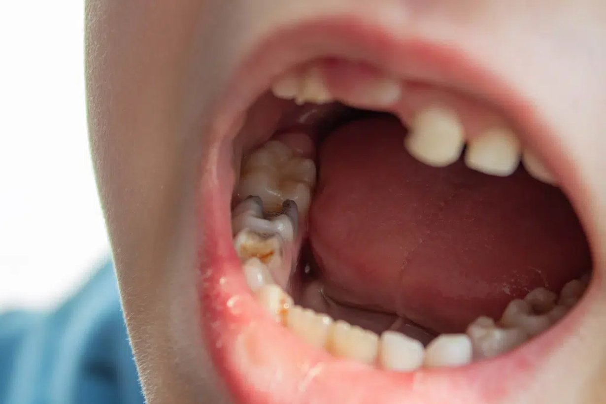 Warning Signs Your Teeth Shouldn’t Ignore