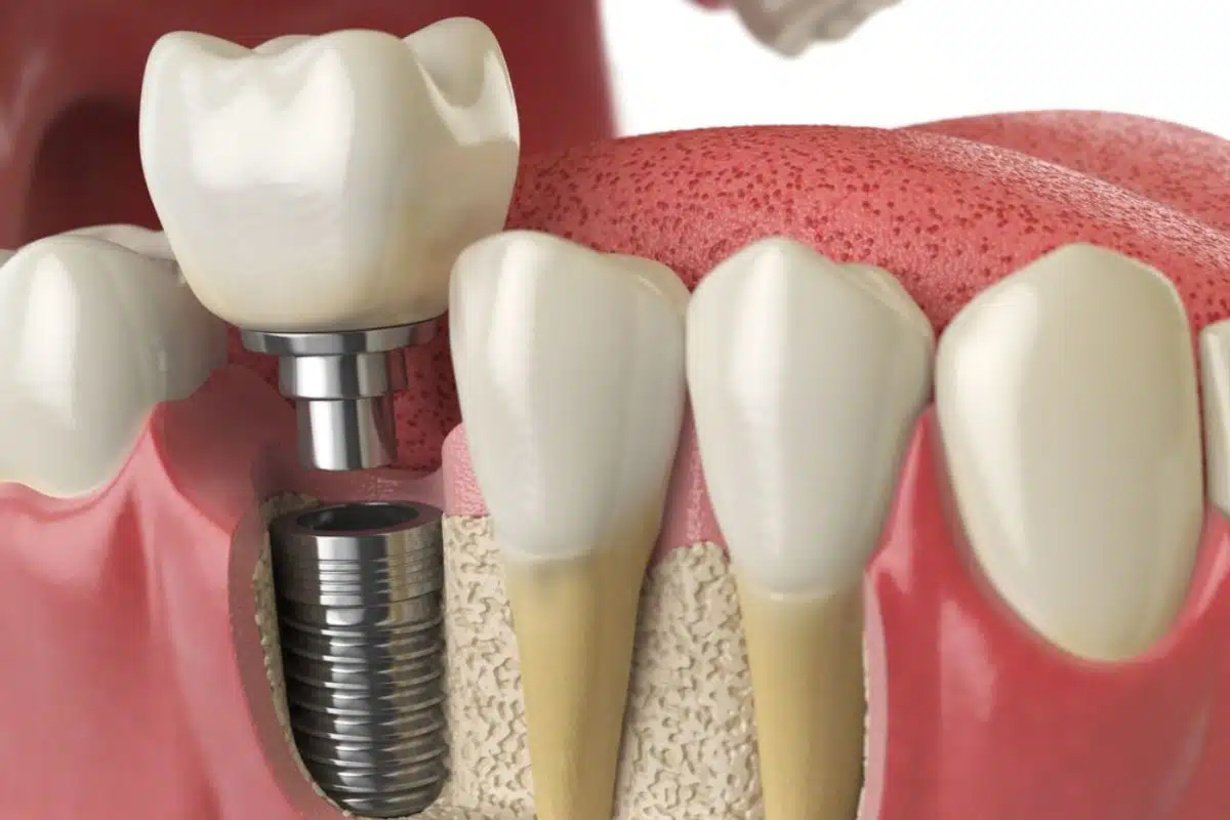 Problems and Complications with Dental Implants