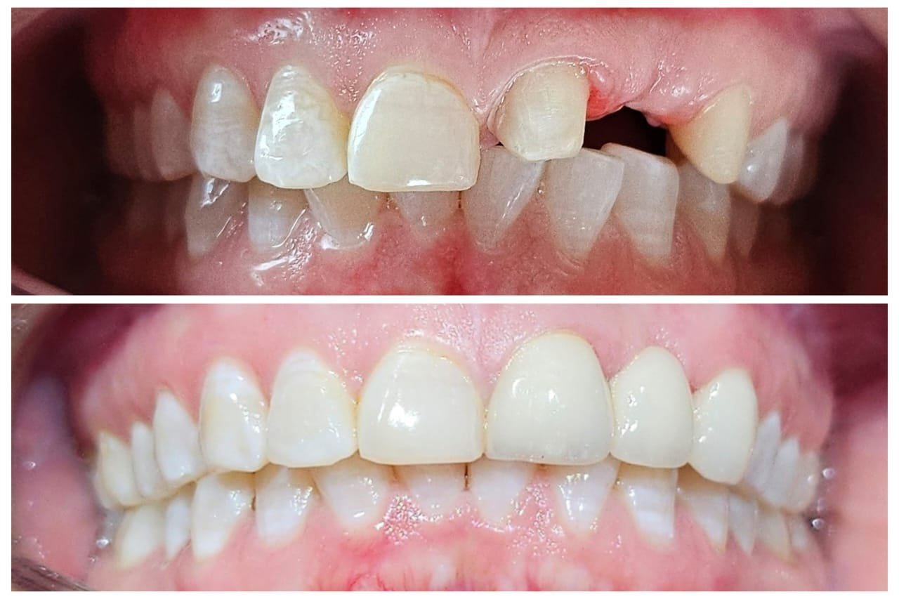 Before and After 1