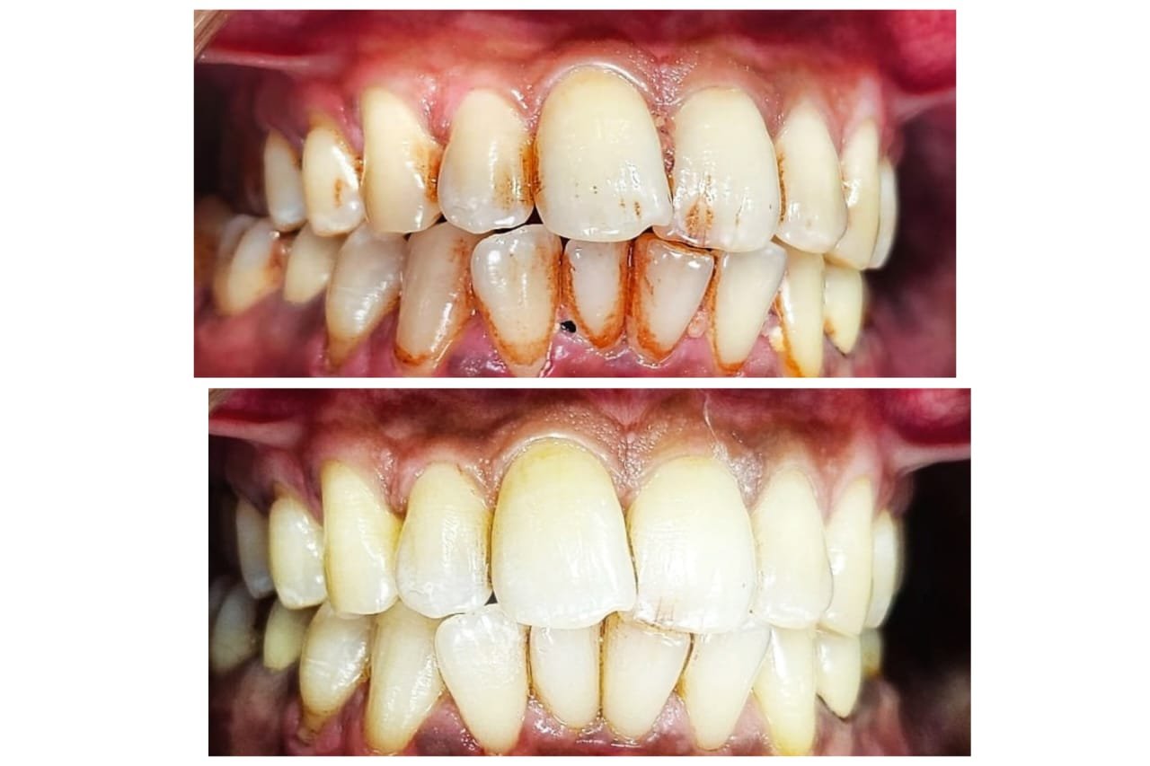 Before and After 2