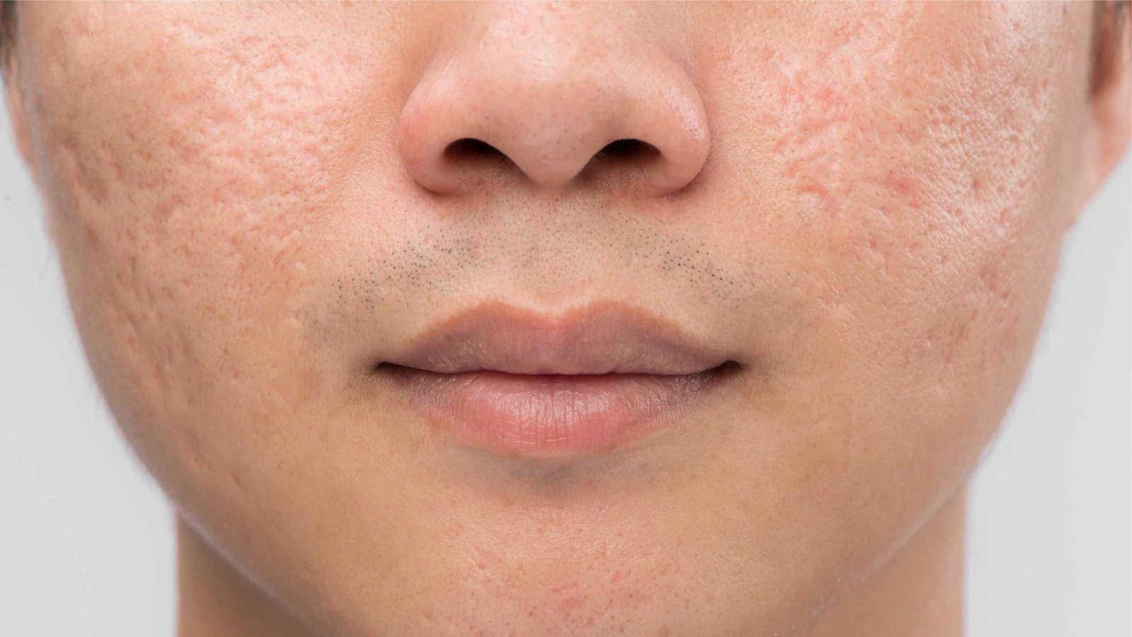Acne Scars Treatments