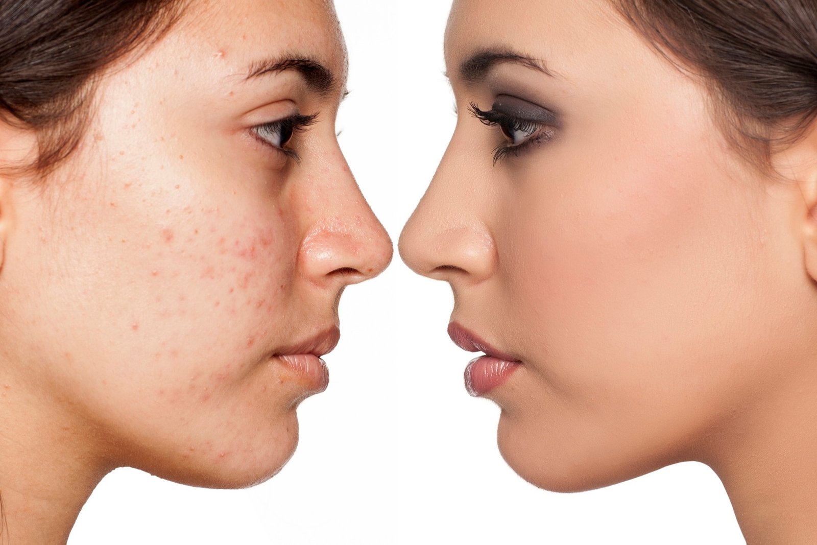 Acne Treatments