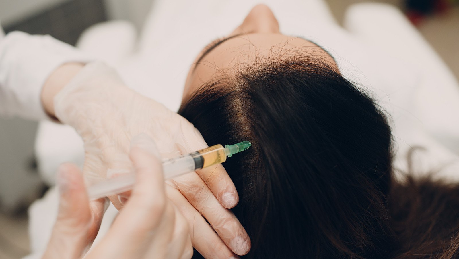 PRP for Hair Restoration
