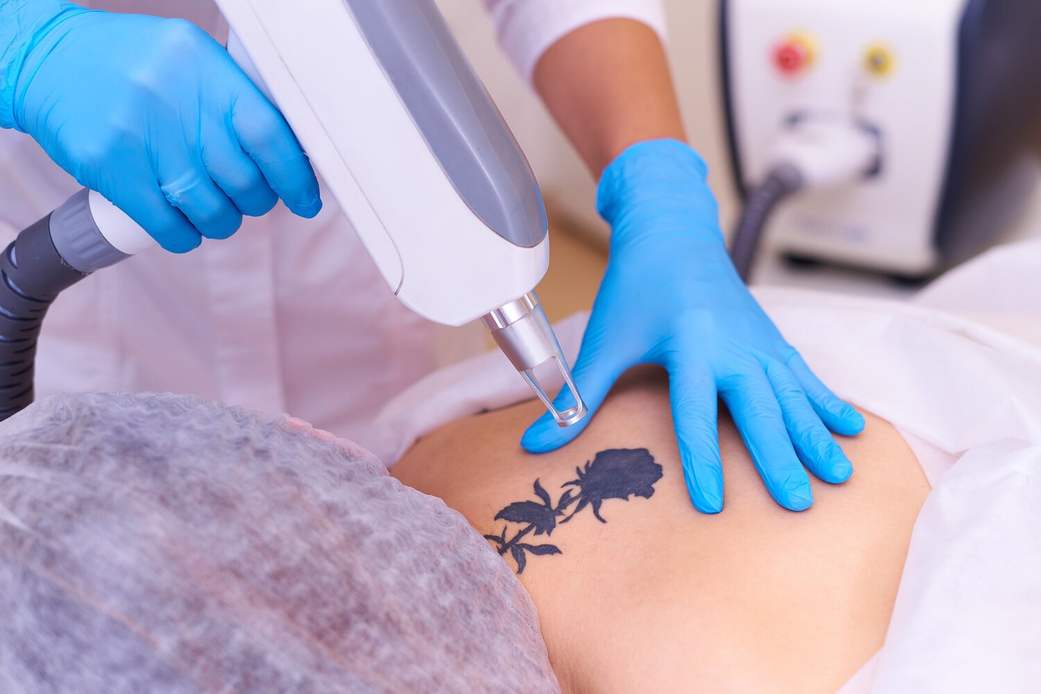 Laser Tatto Removal